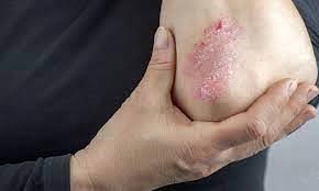 علامات الإصابة بمرض السكري وطريقه علاج السكر في الدم